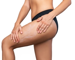 Cómo combatir la celulitis y la flacidez con nuestros tratamientos reductores y reafirmantes