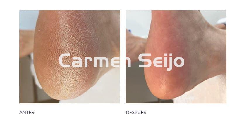 Footlogix Kit Callos y Durezas Footlogix nº18 + Lima Pedicura - Imagen 2